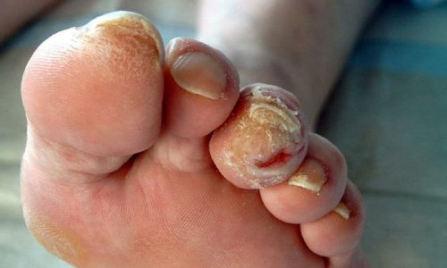 diabetic-foot diabetic-foot